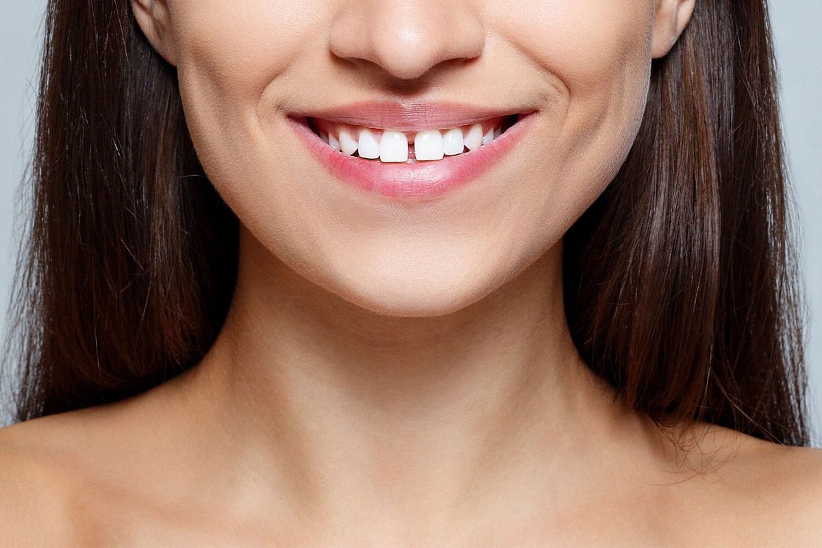 What Causes Gaps in Teeth? – Definition, Symptoms, & Treatments